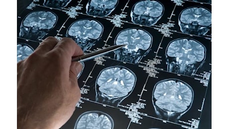 Nuova frontiera anti-Alzheimer, così si combattono le proteine tossiche