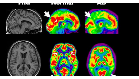 Meno fumo, più attività fisica e vita sociale: la ricetta per prevenire l'Alzheimer